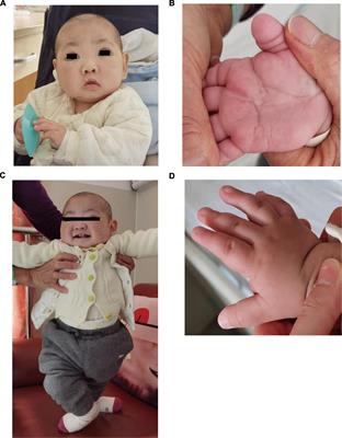 Case report: A study on the de novo KMT2D variant of Kabuki syndrome with Goodpasture’s syndrome by whole exome sequencing